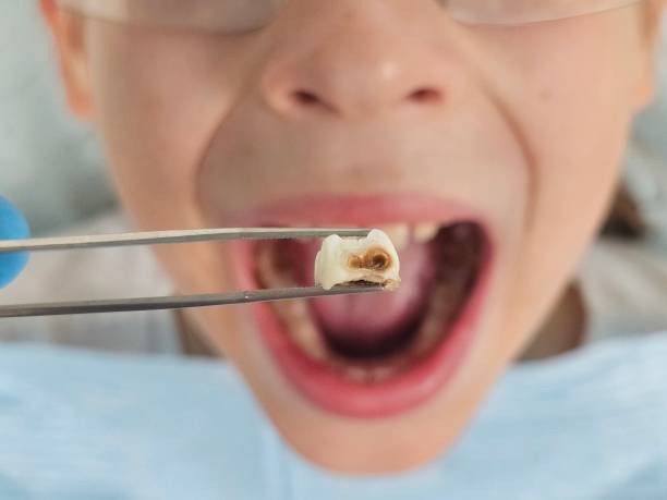 Best Emergency Dental Care for Broken or Chipped Teeth in Monfort Heights, OH