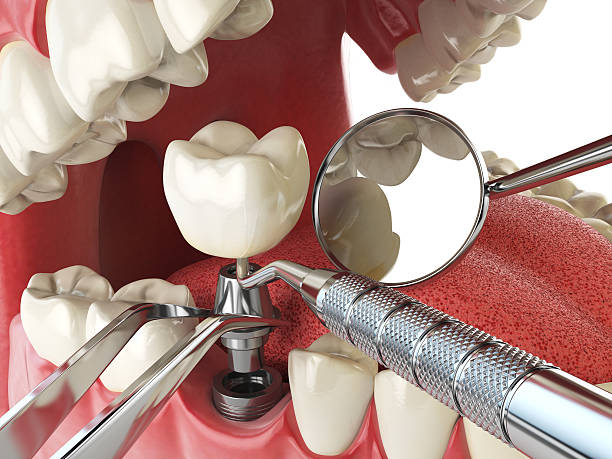Best Urgent Care for Lost Fillings or Crowns in Monfort Heights, OH
