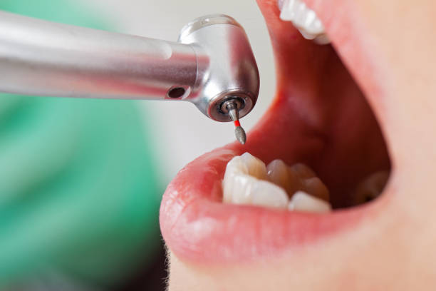Best Emergency Tooth Extraction in Monfort Heights, OH